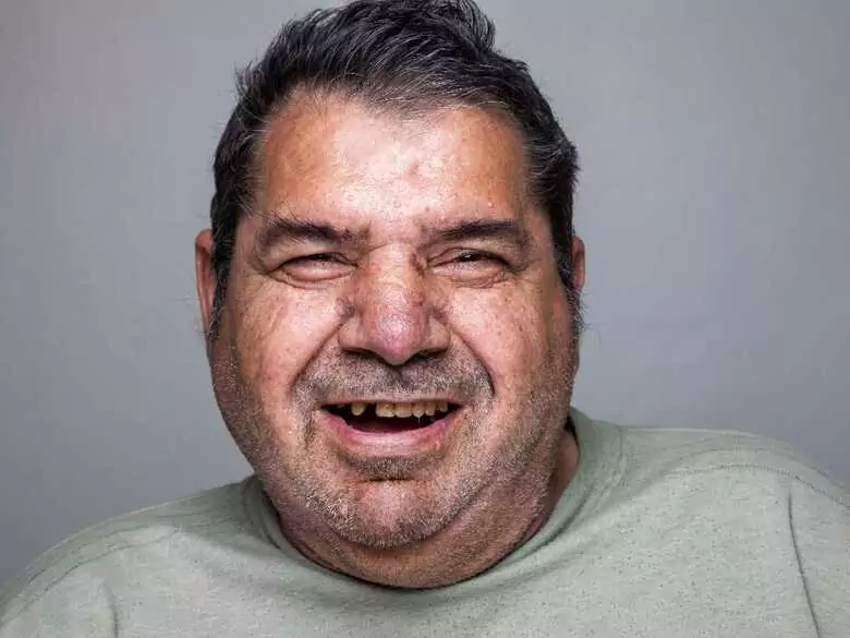 Dlaczego otyłość może zwiększać ryzyko chorób przyzębia?