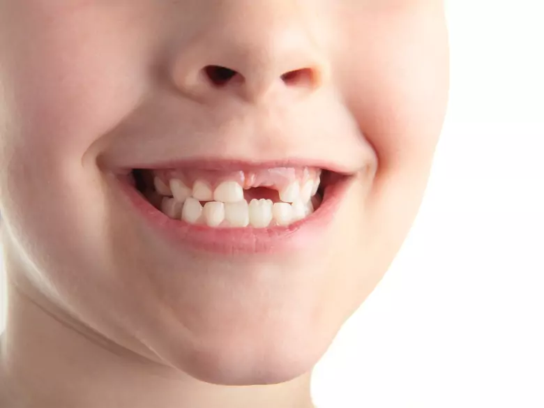 Zęby mleczne jak dbać o nie oraz o przestrzeń po ich wypadnięciu?