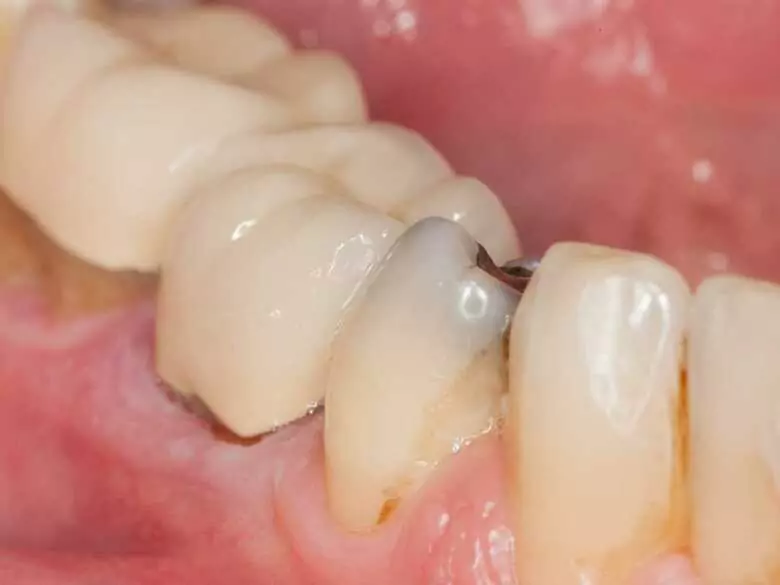 Próchnica nie pyta tylko o to, czy myjesz zęby. Pyta, co jesz i jak często to robisz