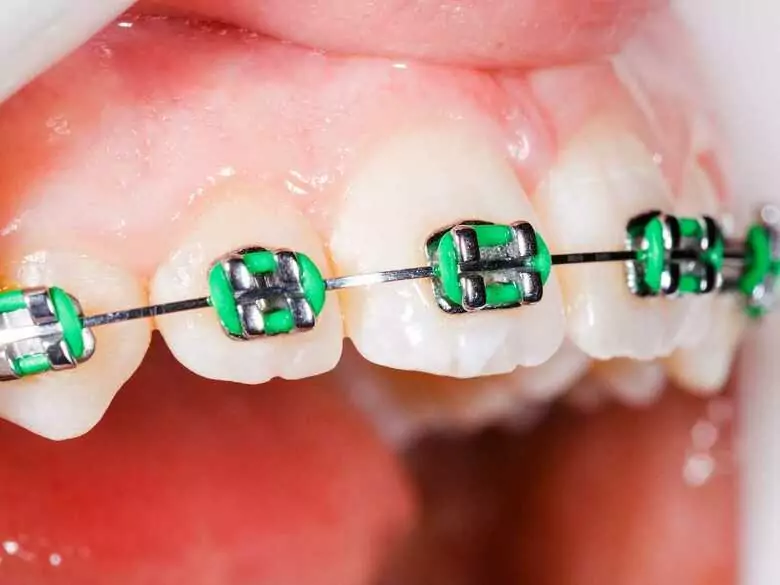 Czy cofanie się dziąseł jest groźne?