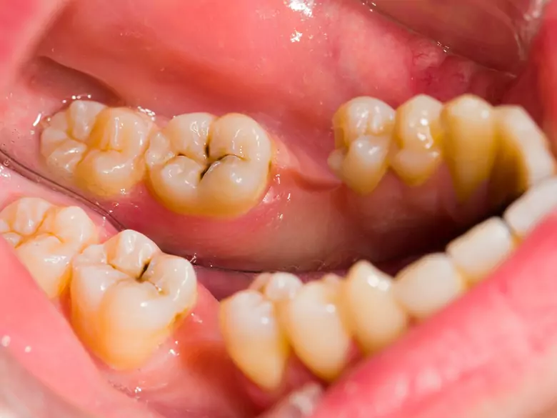 Czynniki ryzyka próchnicy