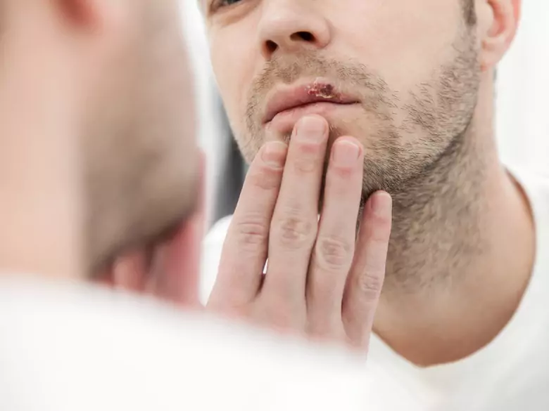 Trzy powody, by nie chodzić do dentysty z opryszczką